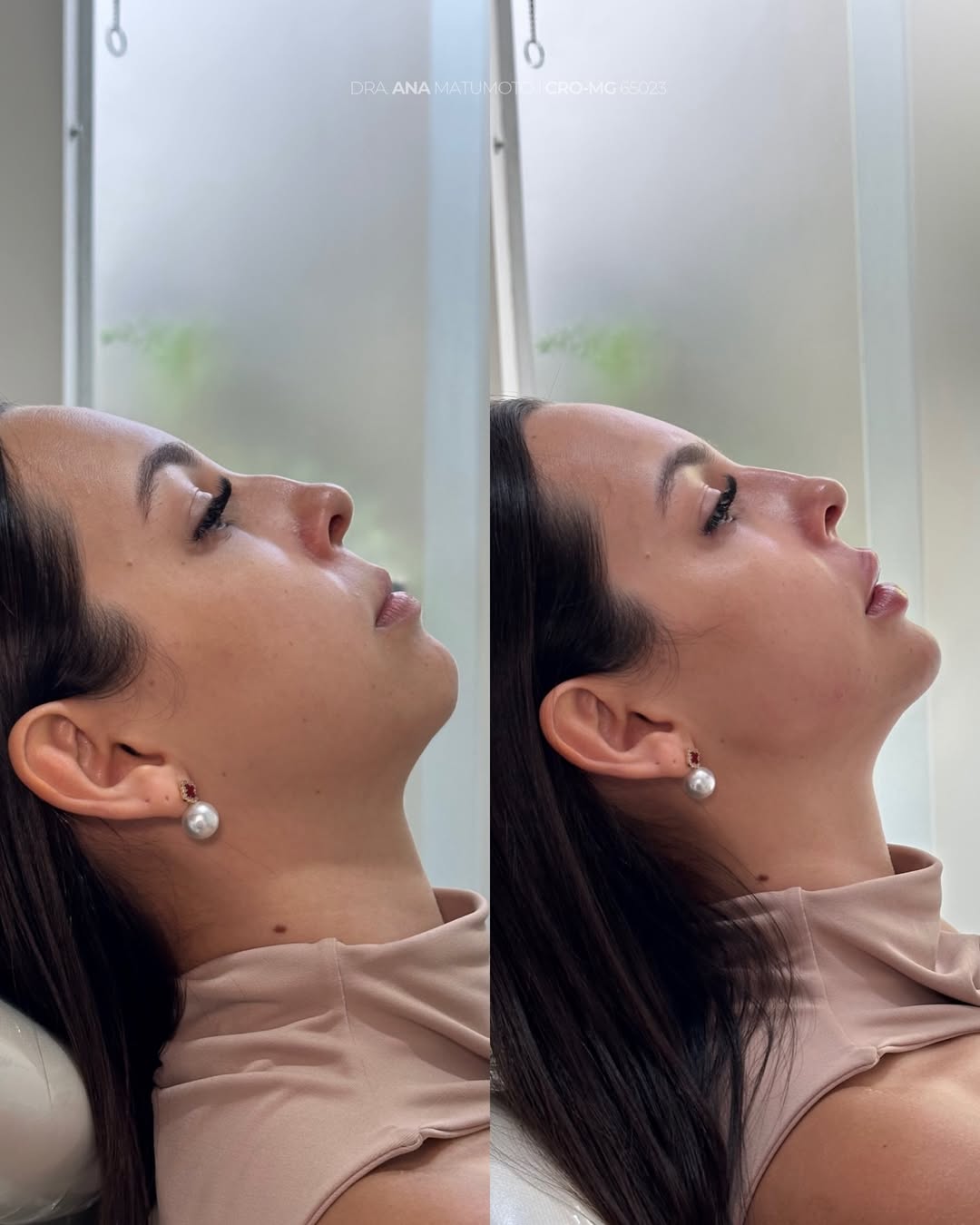Antes e depois — caso 5